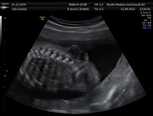 Capture d'écran d'une échographie montrant la malformation dont souffrait le fœtus (Studio Medica via Wikicommons) 