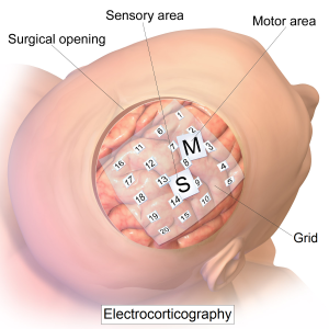 La méthode utilisée par les chercheurs, l'électrocorticographie, par implantation d'électrodes (Ph. Bruce Blaus via Wikicommons CC BY 3.0).