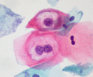 Des cellules de la muqueuse du col de l'utérus d'une femme de 35 infectées par le papillomavirus. - Ph. Ed Uthman / Flickr / CC BY 2.0