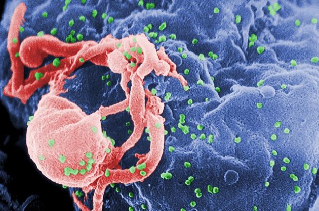 Un lymphocyte T infecté (en rose) libère des virus du sida (en vert) - Ph. CDC/ C. Goldsmith, P. Feorino, E. L. Palmer, W. R. McManus / Wikimedia Commons / domaine public