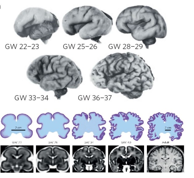 L'évolution réelle du cerveau humain entre la 22e semaine de gestation et la naissance. En bas, clichés IRM et schémas (L. Mahadevan et al. Nature Physics)