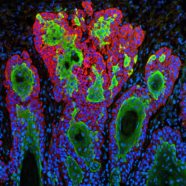 Derrière la croissance et l'expansion chaotiques des cellules cancéreuses, il existerait une loi qui permettrait d'anticiper leur évolution (NIH Image Gallery CC BY 2.0)