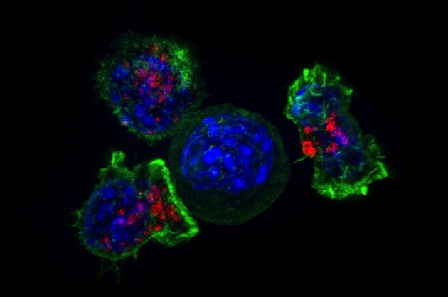 Des lymphocytes T entourent une cellule cancéreuse. A l'aide d'une modification génétique, ils peuvent être dressés pour les tuer sélectivement. - Ph. NICHD / Flickr / CC BY 2.0