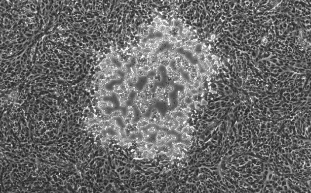Voici l'aspect d'une infection des cellules par le HSV-1 (virus de l'herpès labial) retrouvé chez le sujet analysé. - Ph. Penn State University
